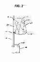 Fig. 04 - STENT CANNULATION GUIDING DEVICE AND METHOD OF USE