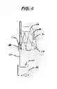 Fig. 05 - STENT CANNULATION GUIDING DEVICE AND METHOD OF USE