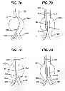Fig. 08 - STENT CANNULATION GUIDING DEVICE AND METHOD OF USE