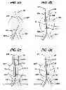Fig. 10 - STENT CANNULATION GUIDING DEVICE AND METHOD OF USE