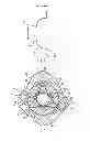 Fig. 06 - Prosthesis having pivoting fenestration