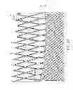 Fig. 04 - Multilayer stent