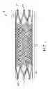 Fig. 09 - Multilayer stent