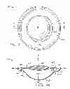 Fig. 03 - Accommodating intraocular lens