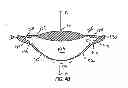 Fig. 04 - Accommodating intraocular lens