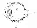 Fig. 06 - Accommodating intraocular lens