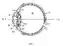 Fig. 07 - Accommodating intraocular lens