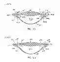 Fig. 10 - Accommodating intraocular lens
