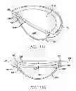 Fig. 12 - Accommodating intraocular lens