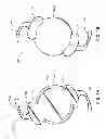 Fig. 02 - CURVATURE CHANGING ACCOMMODATIVE INTRAOCULAR LENS