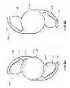 Fig. 04 - CURVATURE CHANGING ACCOMMODATIVE INTRAOCULAR LENS