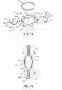 Fig. 02 - ACCOMMODATING INTRAOCULAR LENS