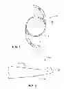 Fig. 02 - Edge design for reducing unwanted photic effects in intraocular lenses