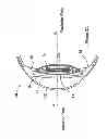 Fig. 03 - Accommodating intraocular lens providing progressive power change