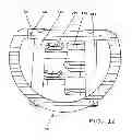 Fig. 17 - Device for securing an implant to tissue