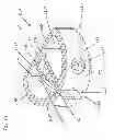 Fig. 52 - Device for securing an implant to tissue