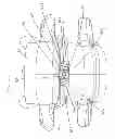 Fig. 63 - Device for securing an implant to tissue