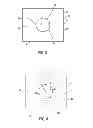 Fig. 04 - Ankle replacement devices and methods of making and using the same