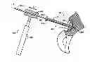 Fig. 01 - DEVICES AND METHODS FOR HIP REPLACEMENT