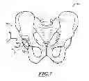 Fig. 08 - DEVICES AND METHODS FOR HIP REPLACEMENT