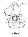 Fig. 09 - DEVICES AND METHODS FOR HIP REPLACEMENT