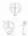 Fig. 37 - Implant components and methods