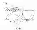 Fig. 56 - Implant components and methods