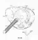 Fig. 65 - Implant components and methods