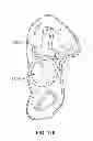Fig. 79 - Implant components and methods