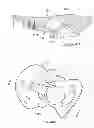 Fig. 92 - Implant components and methods