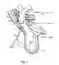 Fig. 02 - Method and prosthesis for percutaneous hernia repair