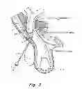 Fig. 04 - Method and prosthesis for percutaneous hernia repair