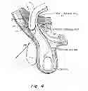 Fig. 05 - Method and prosthesis for percutaneous hernia repair