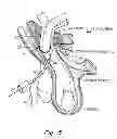 Fig. 06 - Method and prosthesis for percutaneous hernia repair