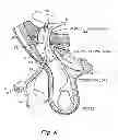 Fig. 07 - Method and prosthesis for percutaneous hernia repair