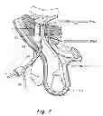 Fig. 08 - Method and prosthesis for percutaneous hernia repair