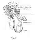Fig. 12 - Method and prosthesis for percutaneous hernia repair