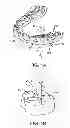 Fig. 02 - Computer automated development of an orthodontic treatment plan and appliance