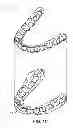 Fig. 03 - Computer automated development of an orthodontic treatment plan and appliance