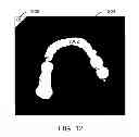 Fig. 20 - Computer automated development of an orthodontic treatment plan and appliance