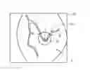 Fig. 01 - Method of selecting a stent based on stress of a blood vessel
