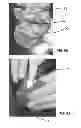 Fig. 07 - Composites for Osteosynthesis