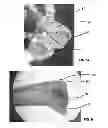 Fig. 08 - Composites for Osteosynthesis