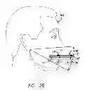 Fig. 22 - Device, system and methods for determining and measuring temporomandibular joint positions and movements