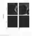 Fig. 10 - Differentiation of human embryonic stem cells into pancreatic endocrine cells using HB9 regulators
