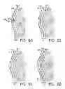Fig. 08 - Moisture management support garment with a denier differential mechanism