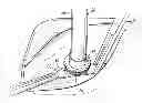 Fig. 01 - DEVICES, METHODS AND SYSTEMS FOR COUNTERPULSATION AND BLOOD FLOW CONDUIT CONNECTION