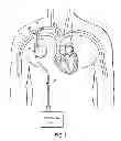 Fig. 02 - DEVICES, METHODS AND SYSTEMS FOR COUNTERPULSATION AND BLOOD FLOW CONDUIT CONNECTION