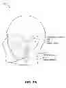 Fig. 04 - NONINVASIVE TISSUE TIGHTENING SYSTEM