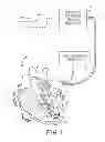 Fig. 02 - Artifact cancellation to suppress far-field activation during electrophysiology mapping